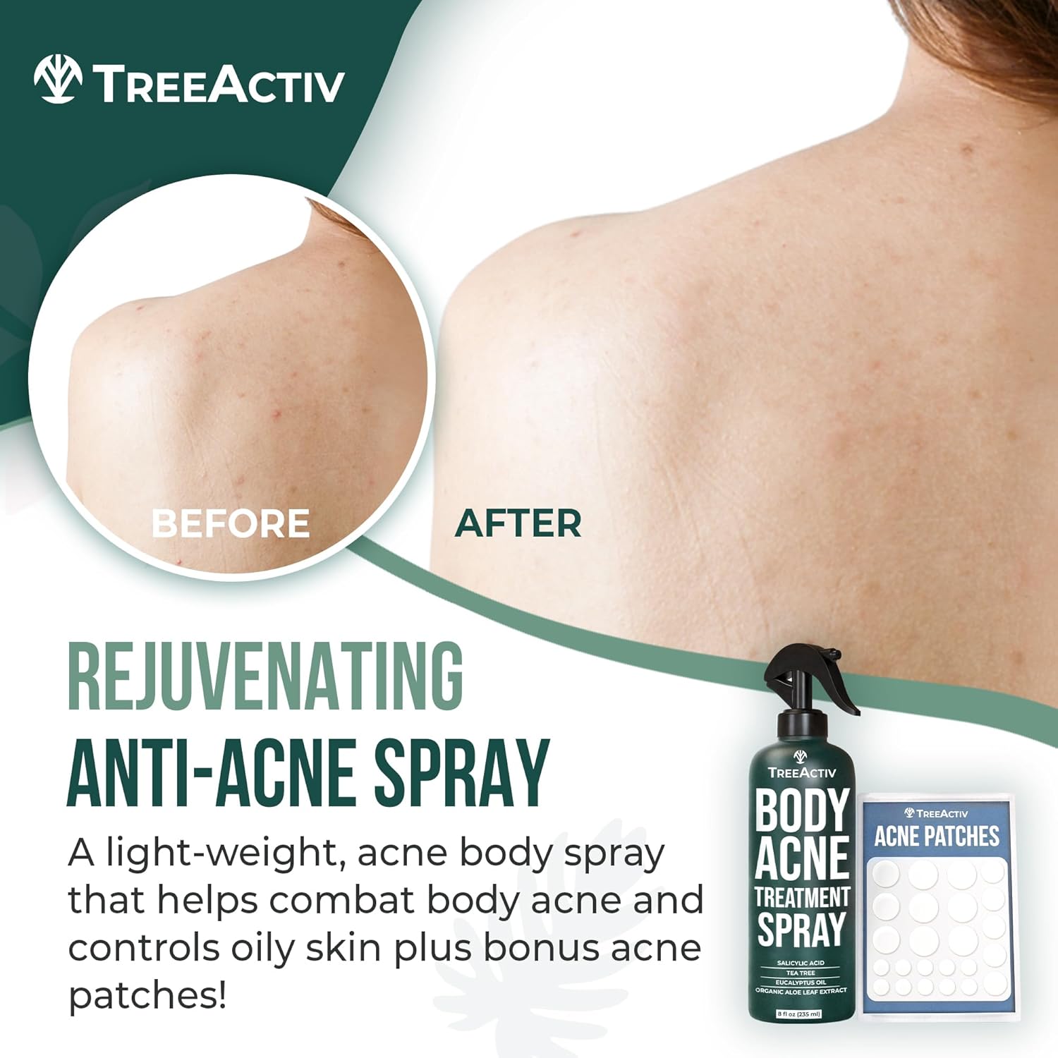 8 fl oz 2% Salicylic Acid Body Acne Treatment Spray N9834